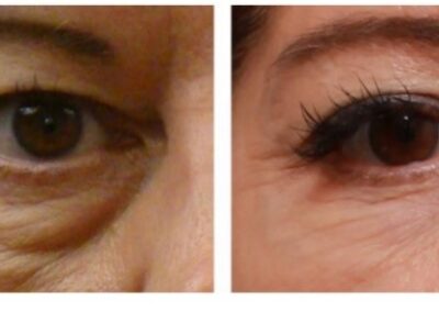 eye-bags-before-and-after