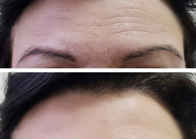 forehead-before-and-after