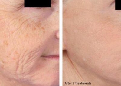 improvement-in-skin-tone-and-texture