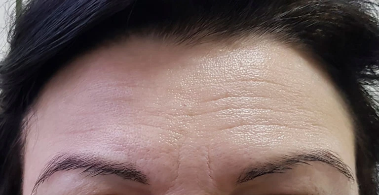 microneedling-before