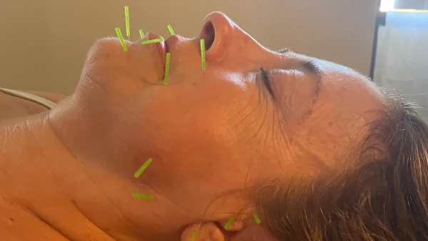 facial acupuncture san diego