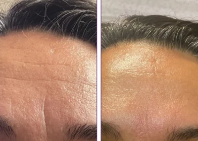 Frown lines Before and immediately after one treatment
